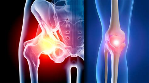 Hip, knee orthopedic surgical implants market to $33B by 2022 - Today's Medical Developments