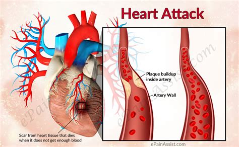 Heart Attack or Myocardial Infarction (MI) | Causes | Risk Factors | Symptoms | Treatment