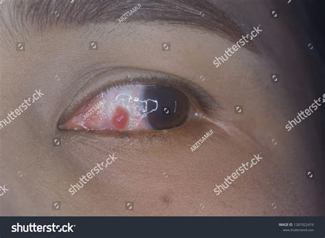 Close Pyogenic Granuloma During Eye Examination Stock Photo 1281922474 ...