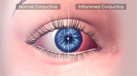 Conjunctivitis