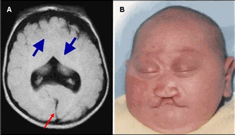 Holoprosencephaly causes, diagnosis, prognosis and treatment