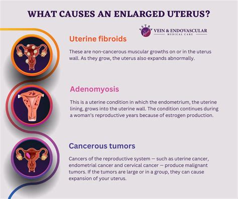 Enlarged Uterus - Vein & Endovascular Medical Care