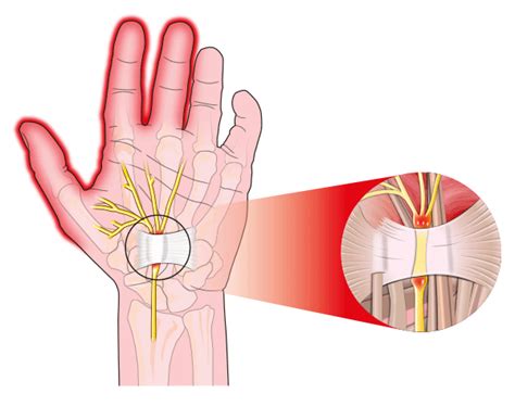 Non-Surgical Cure for Carpal Tunnel- Franklin Rehabilitation