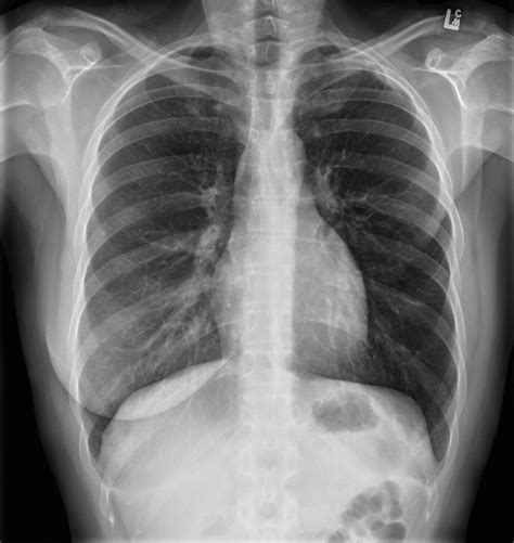 Mastectomy - CXR - Radiology at St. Vincent's University Hospital