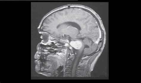 Successful brain tumor surgery performed in Afghanistan - Khaama Press ...