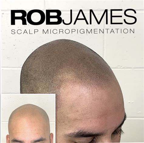 SCALP MICROPIGMENTATION AFTERCARE