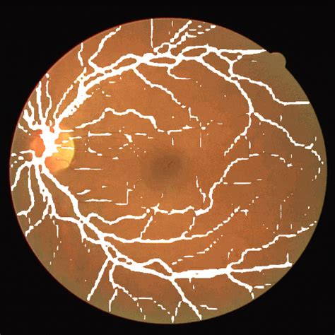 Retinal Vessel Segmentation using PyTorch Semantic Segmentation