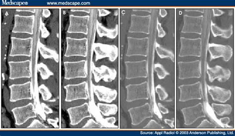 Lumbar Spine: Ct Myelogram Lumbar Spine