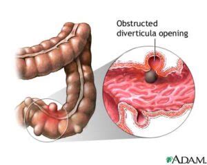 Diverticula, Diverticulosis, Diverticulitis - Chicago Colon and Rectal ...