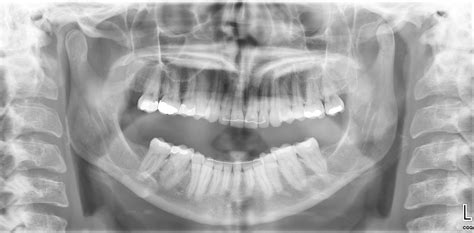 Dislocated Jaw X Ray