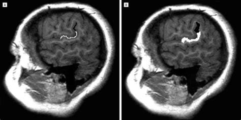 Significance of Planum Temporale and Planum Parietale Morphologic Features in Neurofibromatosis ...