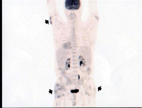 Radionuclide Imaging of Enfuvirtide Injection Sites Reactions in an Hiv ...