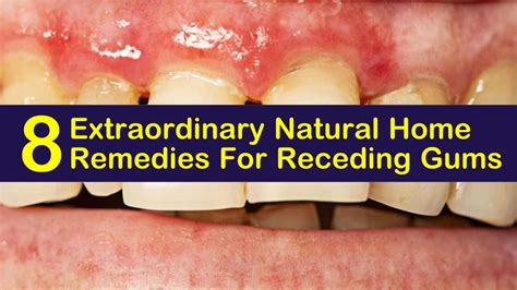 8 Extraordinary Natural Home Remedies For Receding Gums