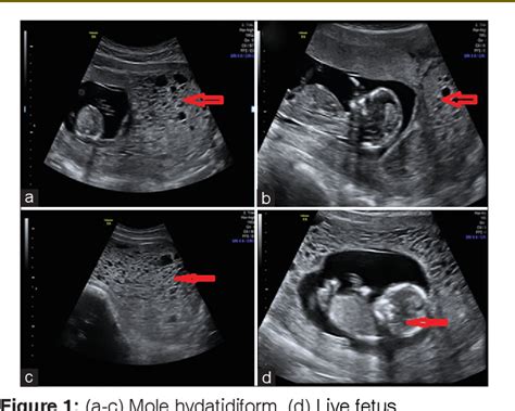 Figure 1 from A Rare Case Report: Partial Molar Pregnancy with a Live ...