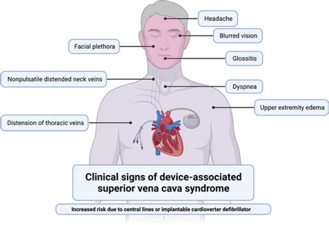 Superior Vena Cava Syndrome Pathophysiology