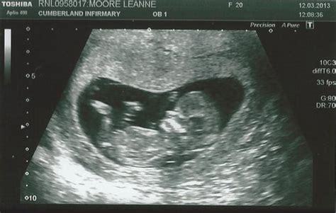 Confirmed genders - can we see your 12 week scan? :) - BabyCenter