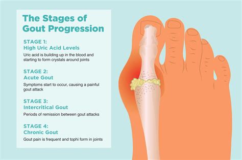 Does Walking On A Gout-Inflicted Foot Aggravate The Condition?