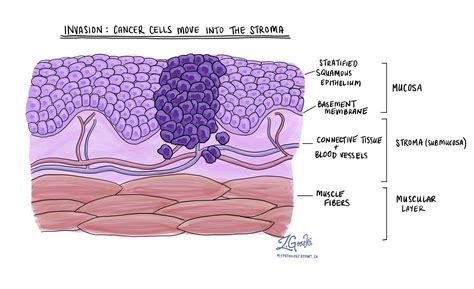 Squamous cell carcinoma of the larynx - MyPathologyReport.ca