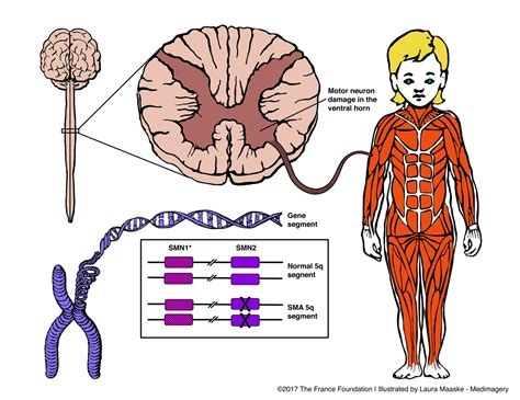 Spinal-Muscle-Atrophy-6colored-small - Medical Illustrations & Animations by Laura Maaske ...