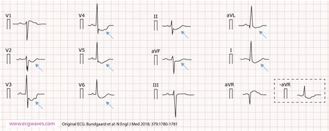 A Novel Familial Cardiac Arrhythmia Syndrome Identified Using ECG – EKG ...