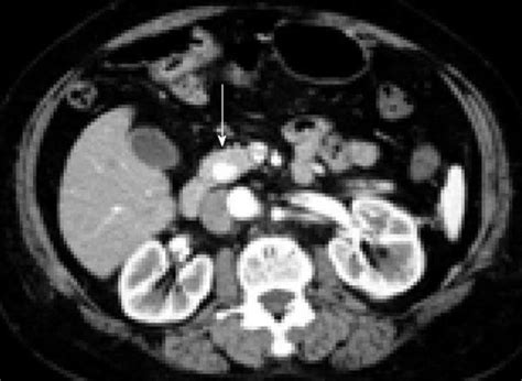 Diagnosis and management of insulinoma