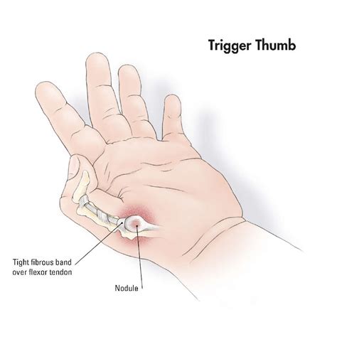 Trigger Finger Diagram