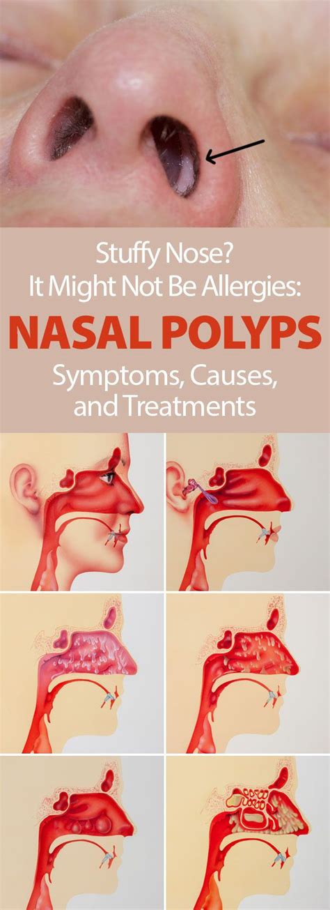 GET RID OF ALLERGIES AND NASAL POLYPS NATURALLY - Health and Wellness ...