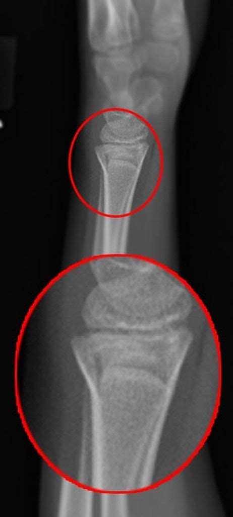 Torus fracture | Radiology Case | Radiopaedia.org | Radiology ...