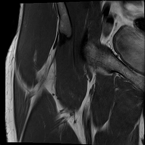 normal hip MRI coronal view 1 Diagram | Quizlet