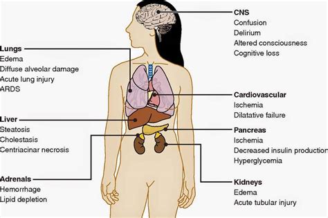 Multiple organ dysfunction syndrome causes, symptoms, diagnosis & treatment