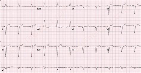 Third Degree AV Block with Ventricular Pacing ECG | Learn the Heart