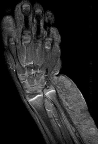 MR Imaging of Soft-Tissue Vascular Malformations: Diagnosis, Classification, and Therapy Follow ...