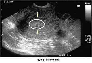 Uterus (neck) polyps ~ All About Women Health