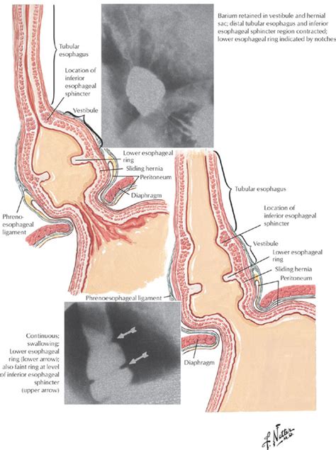 Figure 7 | Pharyngeal and esophageal diverticula, rings, and webs : GI Motility online