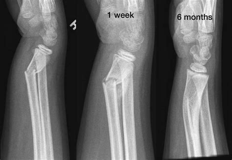 Radius Bone Fracture