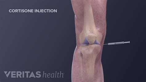 Q&A: Why Cortisone Injections Can Be Controversial