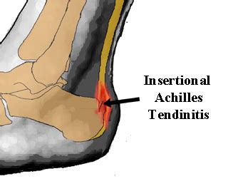 Ways to Manage Insertional Achilles Tendonitis | New Health Guide