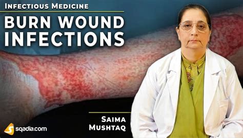 Burn-Wound Infections