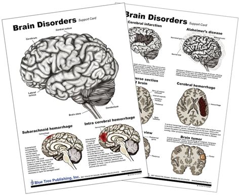 Brain Disorders Anatomical Chart - Etsy