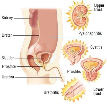 Patient Basics: Urinary Tract Infection in Men | 2 Minute Medicine