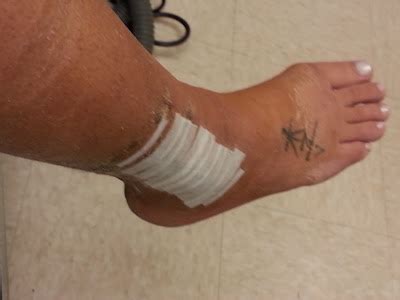 My Broken Ankle =(: Cast Removal Day!