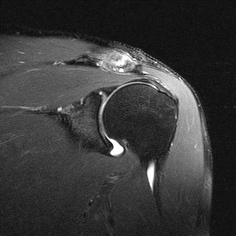 Type 2 SLAP Tear - Musculoskeletal Case Studies - CTisus CT Scanning