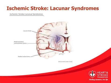 Lacunar Stroke