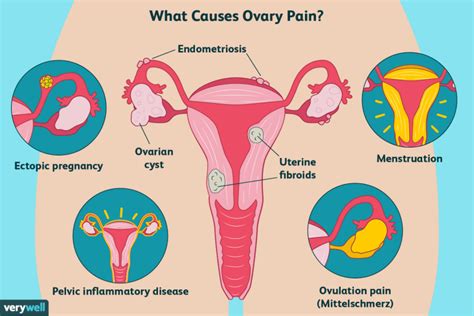 Ovarian cyst and its Homeopathic Treatment | Kidney Failed