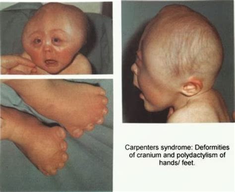 Medical Treatment Pictures-for Better Understanding: Carpenter Syndrome