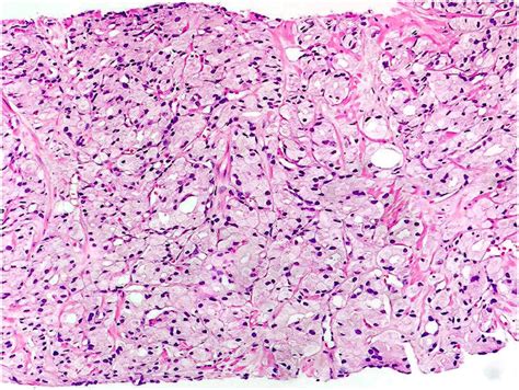 Foamy gland variant of adenocarcinoma of prostate: a rare pathological variant | BMJ Case Reports