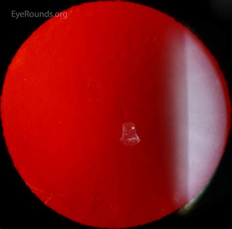 Posterior Polymorphous Corneal Dystrophy (PPMD)