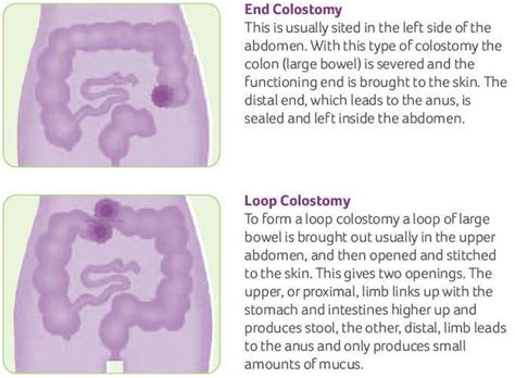 Colostomy - How To Change A Colostomy Bag & Living With It