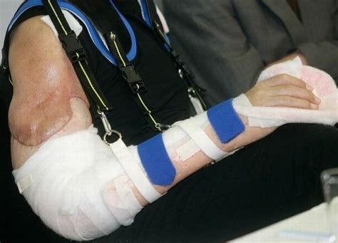 A Farmer Has Double Arm Transplant - XciteFun.net