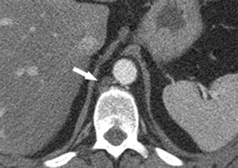 The Diaphragmatic Crura and Retrocrural Space: Normal Imaging Appearance, Variants, and ...